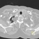 Pachypleuritis, apical, postspecific changes: CT - Computed tomography